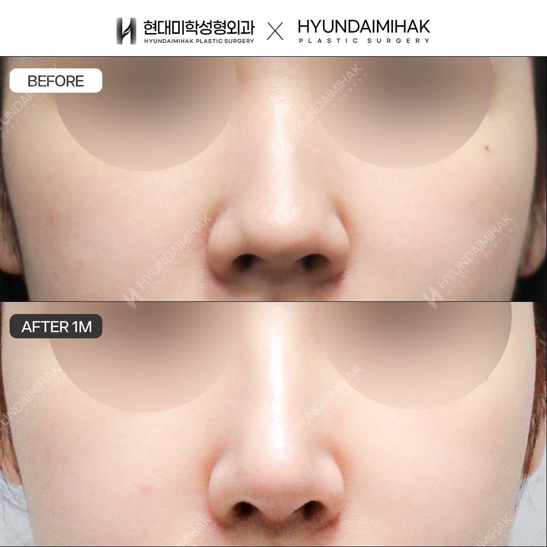 [Phẫu thuật mũi gồ] Sống mũi + đầu mũi sau 1 tháng