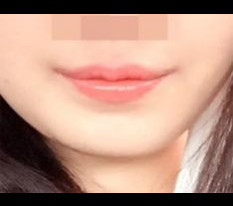 Phẫu thuật góc môi thật kỳ diệu