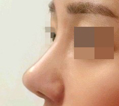 Mới phẫu thuật chưa lâu mà đã thích rồi