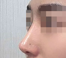 Sau khi làm mũi tôi liên tục được nói trở nên đẹp trai