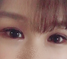 Mắt tôi thay đổi hoàn toàn nhờ phẫu thuật mắt hai mí ♥