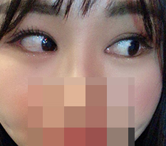 Dual canthoplasty thật sự làm thay đổi ấn tượng rất nhiều ^^