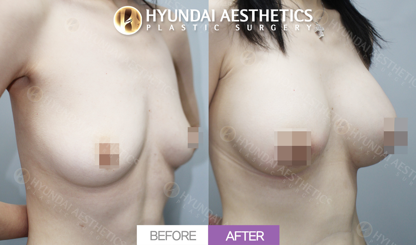 Chỉnh ngực chảy xệ + chỉnh thể tích ngực