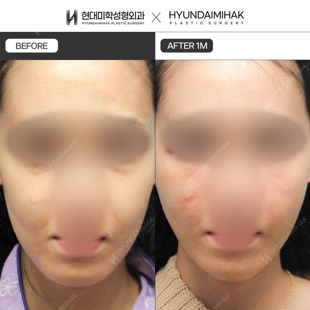 [Phẫu thuật trẻ hóa] Căng chỉ sau 1 tháng