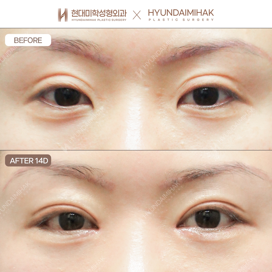 [Tái phẫu thuật mắt] Hạ đường nếp mí bằng đường cắt + chỉnh cơ nâng mi + mở góc mắt trong