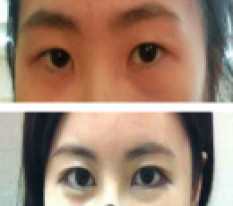 Tìm lại sự tự tin chỉ với phẫu thuật mắt♥
