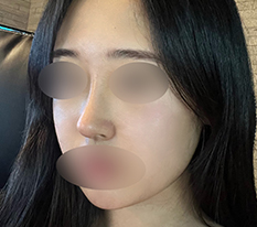 Đã có chiếc mũi tự nhiên sang đẹp