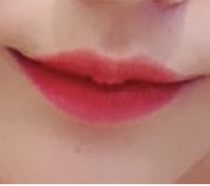 Sau phẫu thuật khóe môi, diện mạo thay đổi nhiều lắm ㅎㅎ
