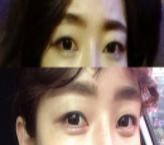 Sau tiêm filler, mình thành cô nàng đáng yêu >3<