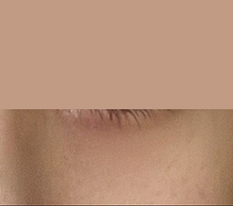 Ấn tượng thay đổi nhờ tái định vị mỡ dưới mắt!