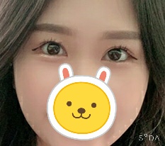 When it comes to eyes, Thẩm mỹ Hyundai really seems right haha