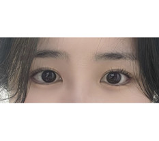 Review canthoplasty ngoài và dưới của tôi~~~
