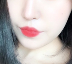 Rất rất hài lòng với phẫu thuật khóe miệng!!