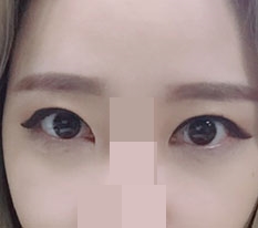 Tôi đã làm mí đôi và mở khóe kép!
