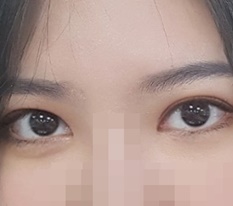 Review cắt mí và mở góc mắt trong : )