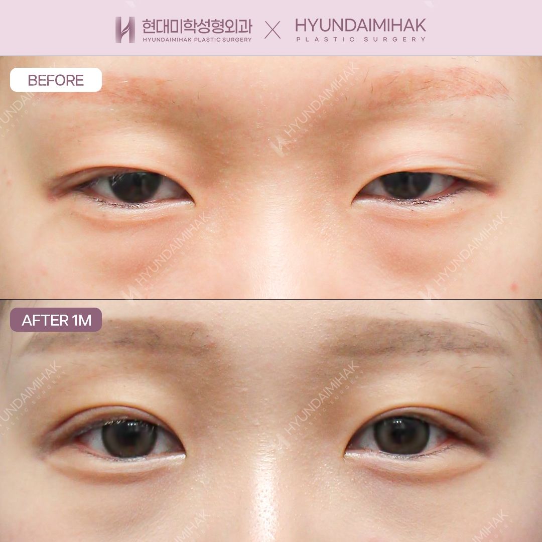 Cắt mí toàn phần + chỉnh cơ nâng mi