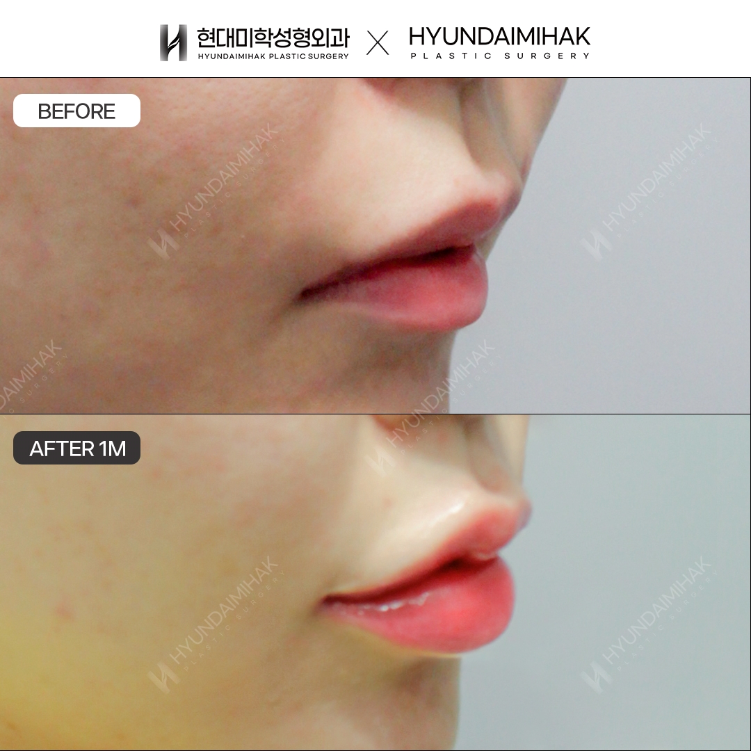 Tạo hình khóe miệng, chỉnh bất đối xứng sau 1 tháng