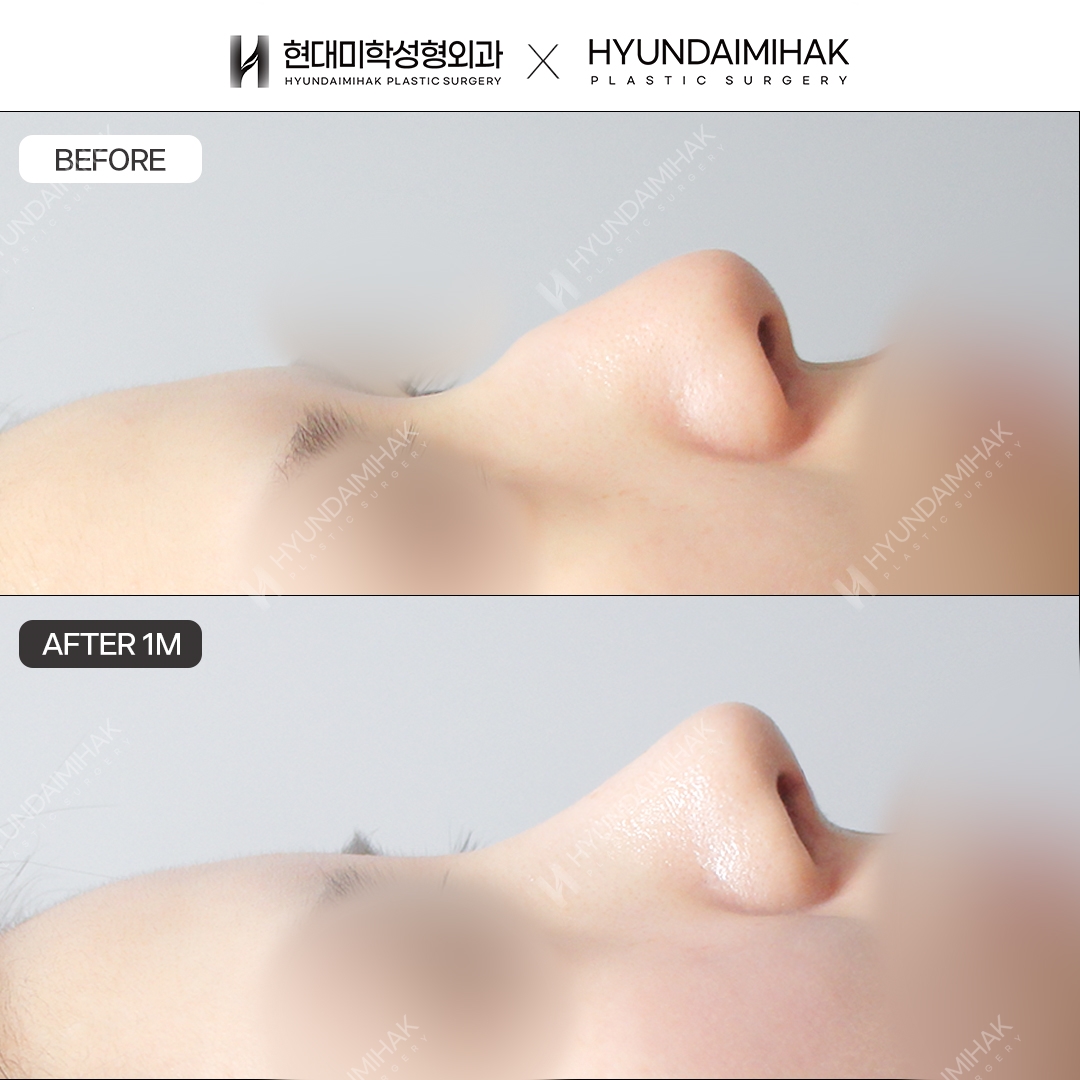 [Phẫu thuật mũi gồ] Sống mũi + đầu mũi sau 1 tháng