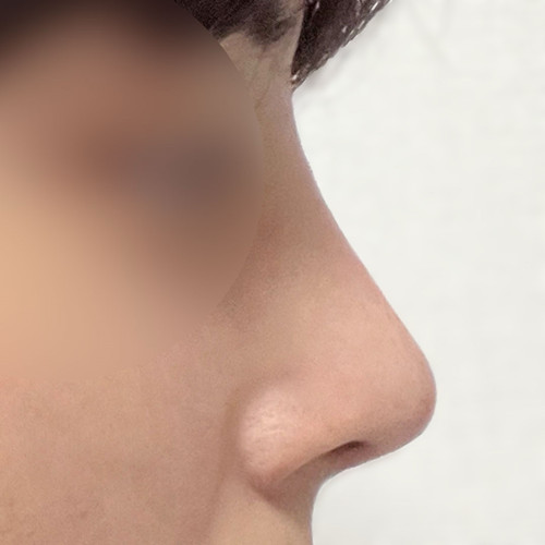 Hành trình lần đầu phẫu thuật mũi của nam giới