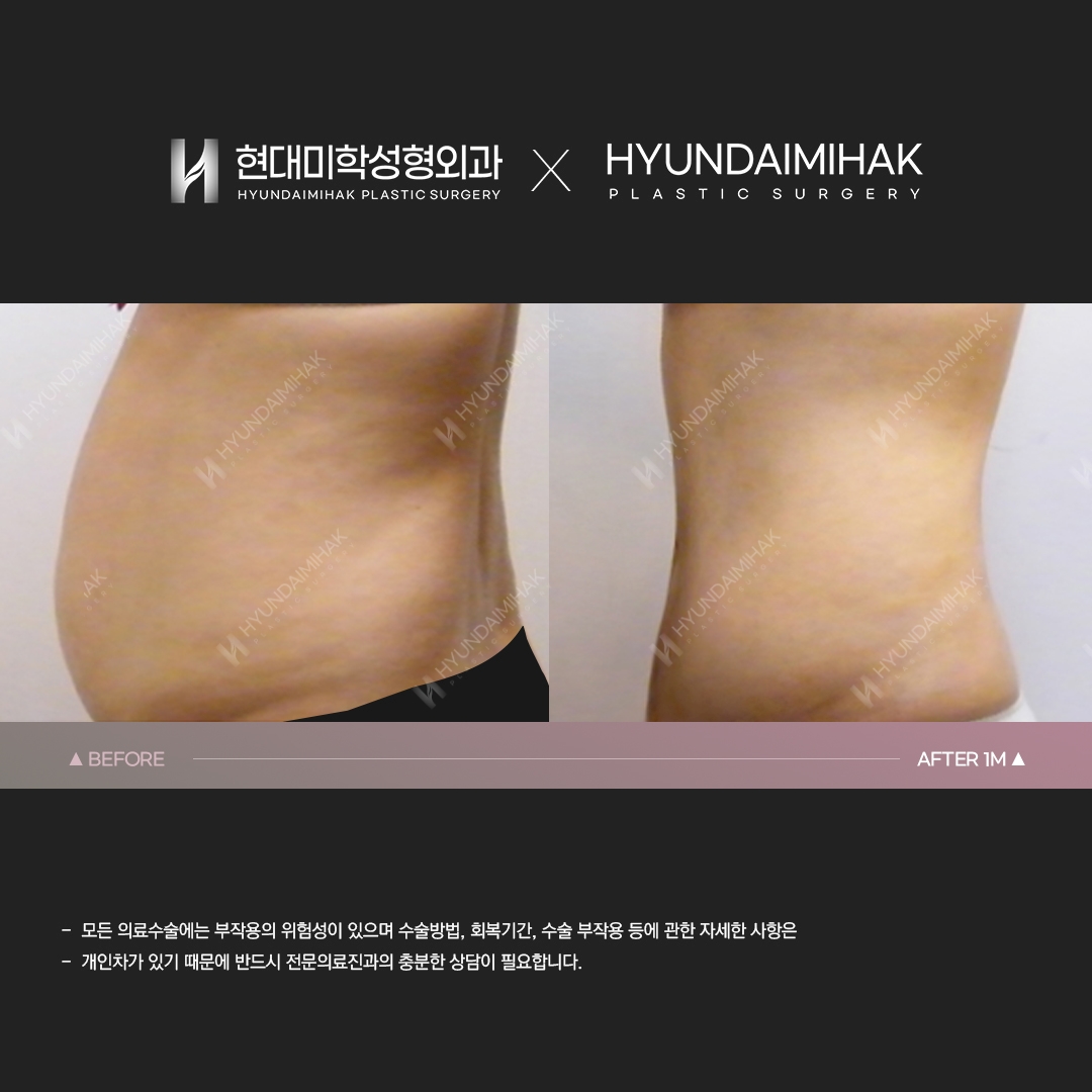 Hút mỡ bụng sau 1 tháng