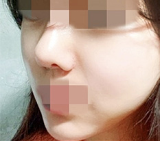 Tôi đã phẫu thuật gọt mặt, đăng review đây ㅎㅎ