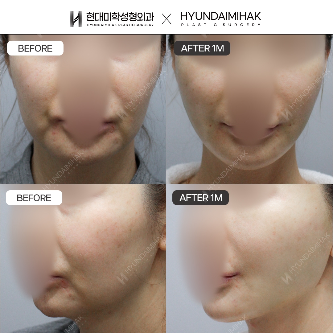 [Phẫu thuật trẻ hóa] Căng chỉ sau 1 tháng