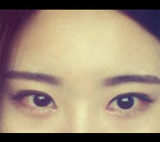 Review phẫu thuật mắt của tôi ㅎㅎㅎ