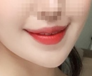 Review phẫu thuật khóe miệng!!!!