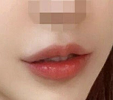 Để lại review kỷ niệm phẫu thuật khóe miệng ㅎ