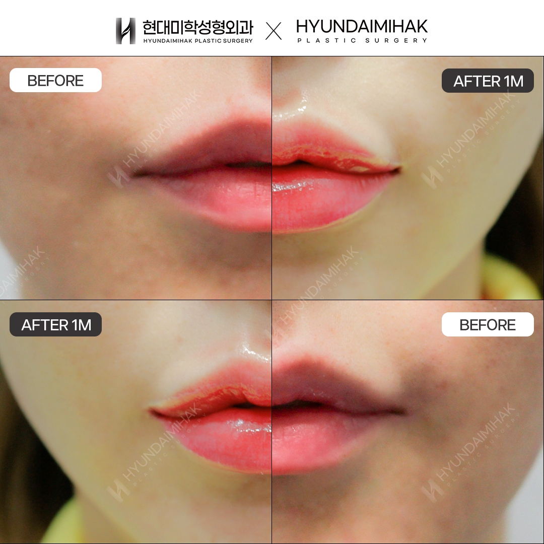 Tạo hình khóe miệng, chỉnh bất đối xứng sau 1 tháng
