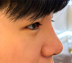 Tôi đã phẫu thuật mắt và mũi (nam giới)