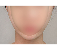Cực kỳ hài lòng với mũi tiêm tan mỡ> . <