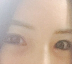 Tôi đã làm phẫu thuật sửa mắt ㅠㅠㅠㅠ