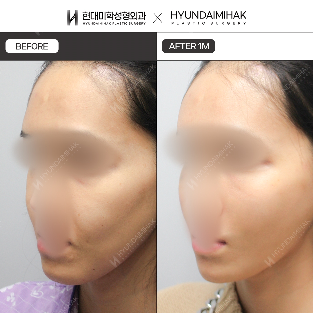 [Phẫu thuật trẻ hóa] Căng chỉ sau 1 tháng