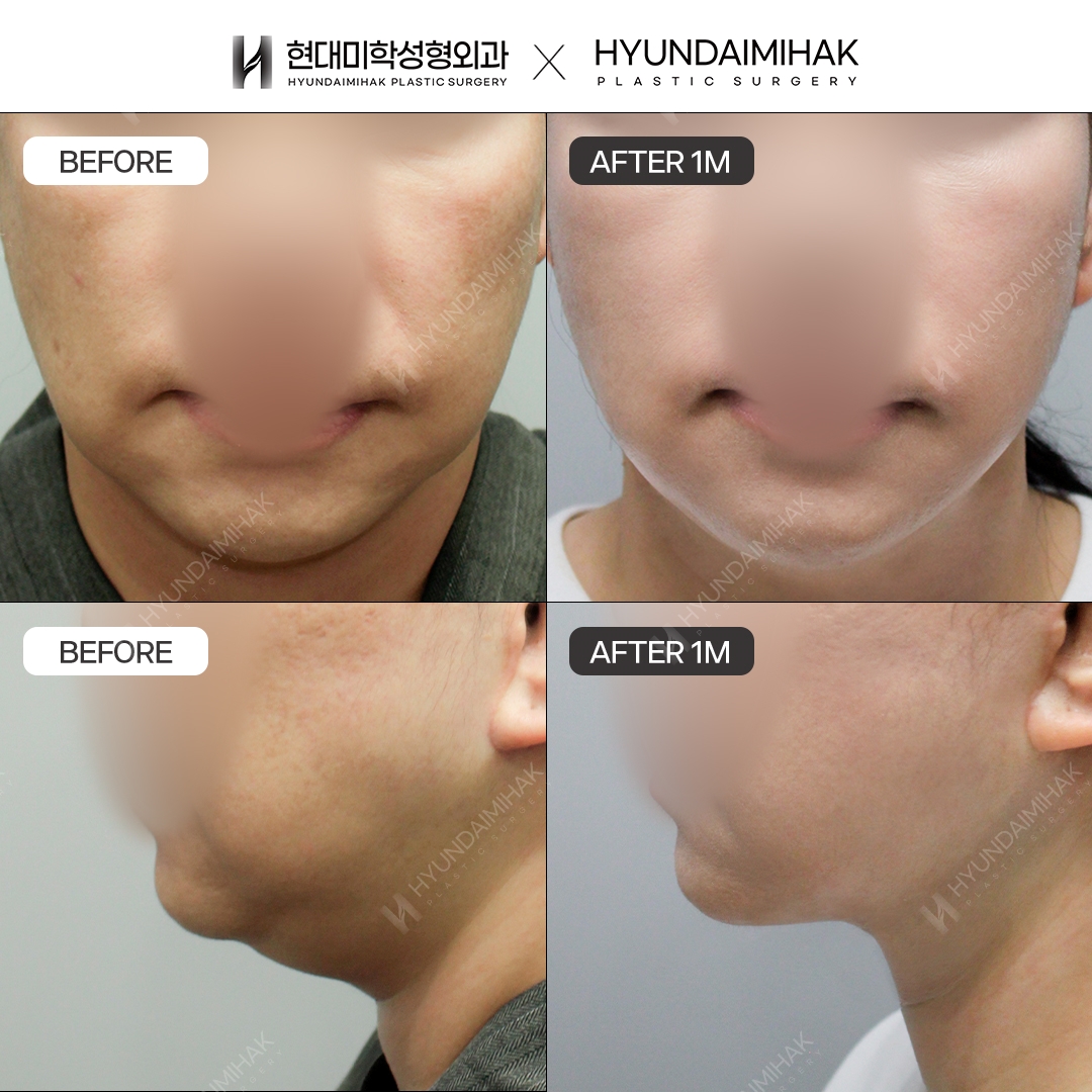 [Phẫu thuật trẻ hóa] Căng chỉ sau 1 tháng