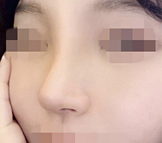 Cuối cùng đã làm mũi sau bao lần đắn đo ㅎㅎ Thành công rồi~