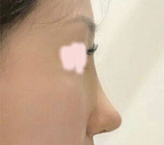 Chia sẻ review phẫu thuật mũi nhé — các bạn thấy sao??