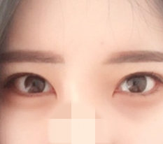 Phẫu thuật mở đuôi mắt và khóe mắt dưới!