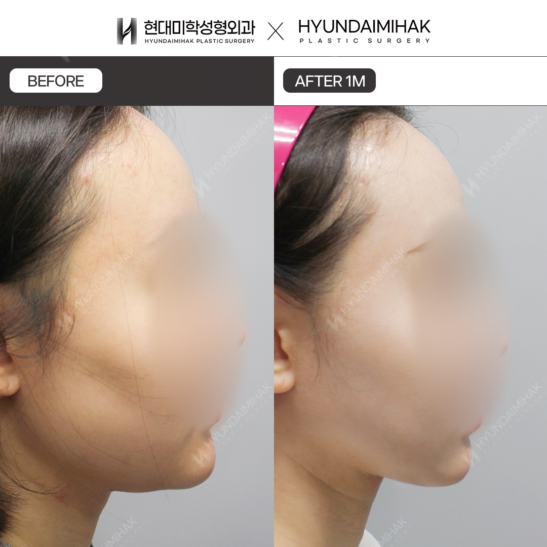 [Nang co] Cang chi nong cam, sau 1 thang