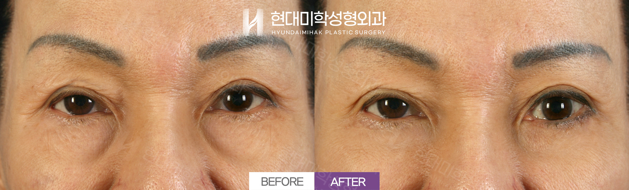 Tái định vị mỡ dưới mắt