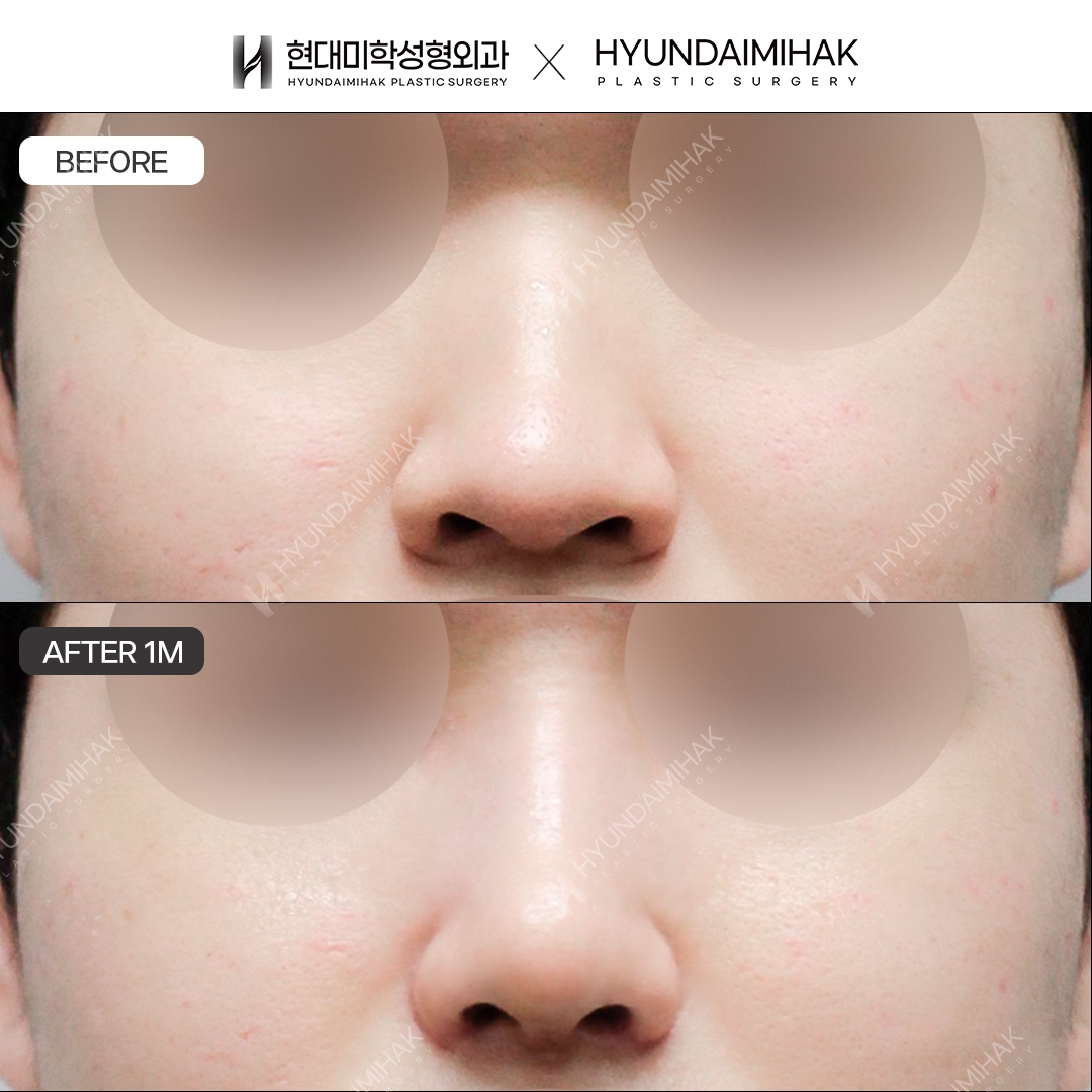 [Nâng mũi nam] Sống mũi + đầu mũi, sau 1 tháng