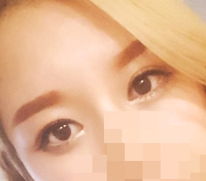 Rất khuyến nghị phẫu thuật mắt!!!!