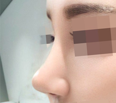 Nhìn cái mũi đẹp lên mà cảm thấy thành công rồi ㅋ
