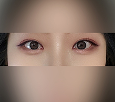 Trước đây nếp mí quá đậmㅠ
