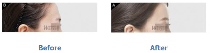 Phẫu thuật trẻ hóa + Cấy mỡ trán