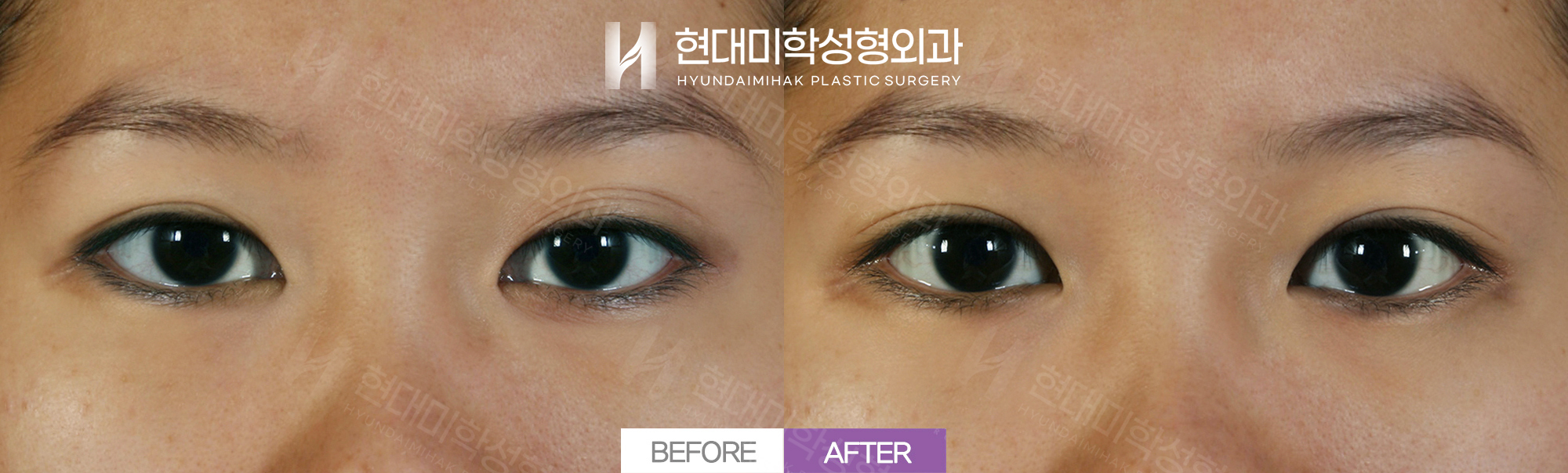 Nhấn mí tự nhiên + phẫu thuật lại mí đôi