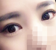 Cắt mí + chỉnh cơ nâng mi + mở khóe trước, sau, dưới