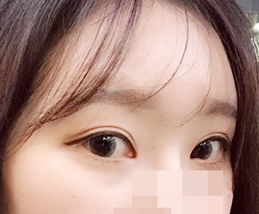 Phẫu thuật mắt quá đỉnh>.<