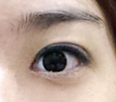 The Big Eye eye-enlargement surgery effect is so good