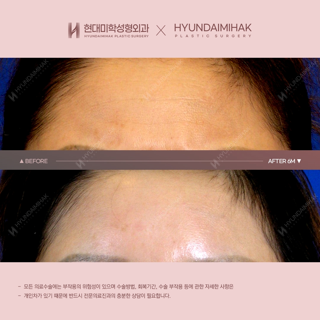 [Phẫu thuật trẻ hóa] Nâng trán sau 6 tháng